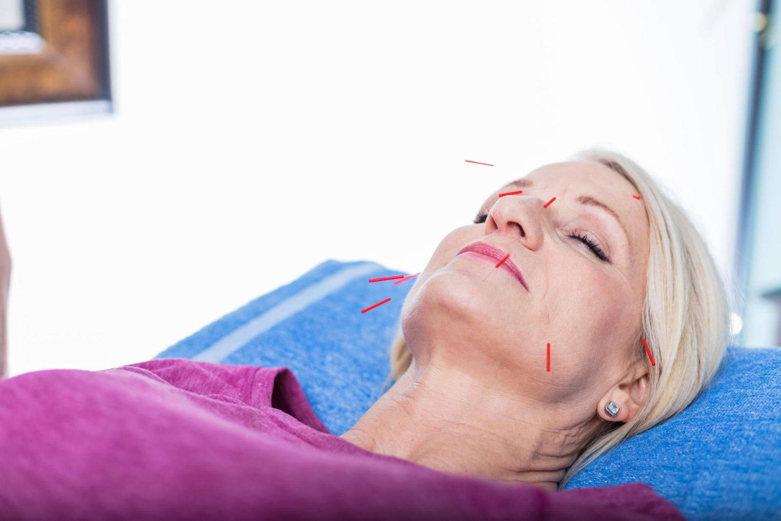Aesthetic Acupuncture